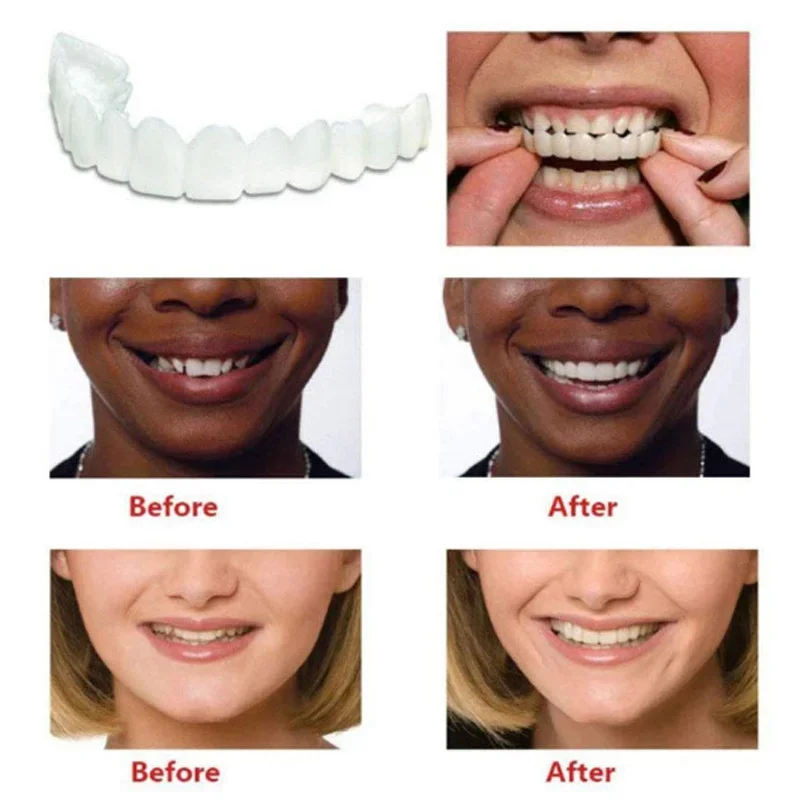 Denture Cover Veneer Snap-on T - Teeth Whitening Veneers recensie en prijs