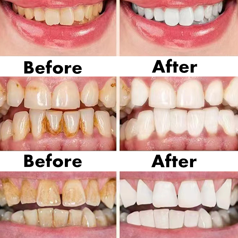 Teeth Whitening Pen Dental Ess - Whitening Pen Bleach recensie en prijs