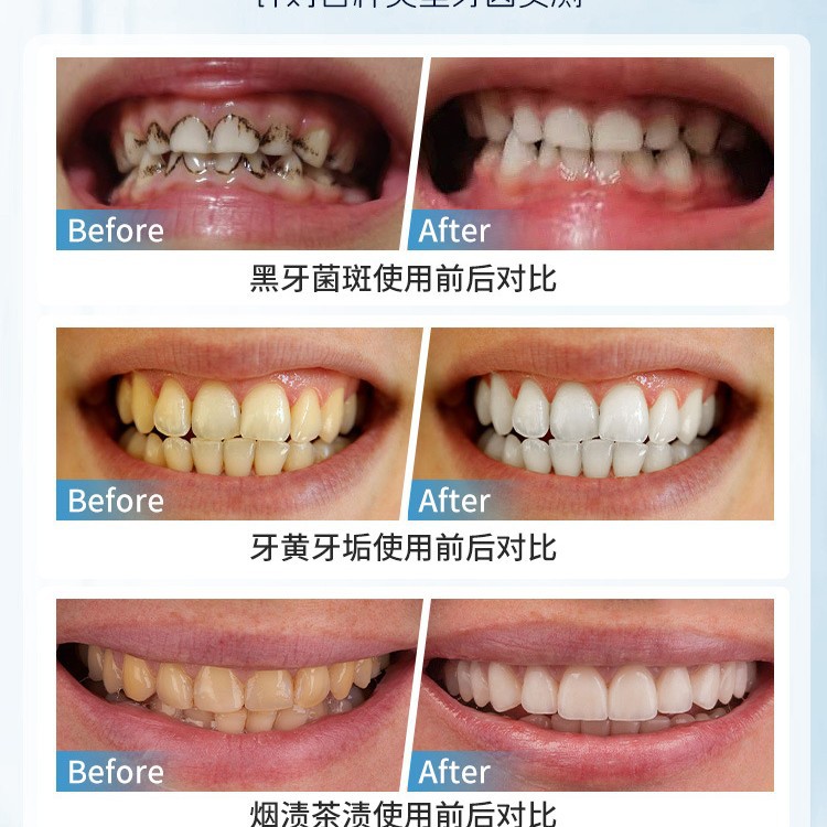 Japan Manual Tooth Stain Remov - Teeth Whitening In Japan recensie en prijs