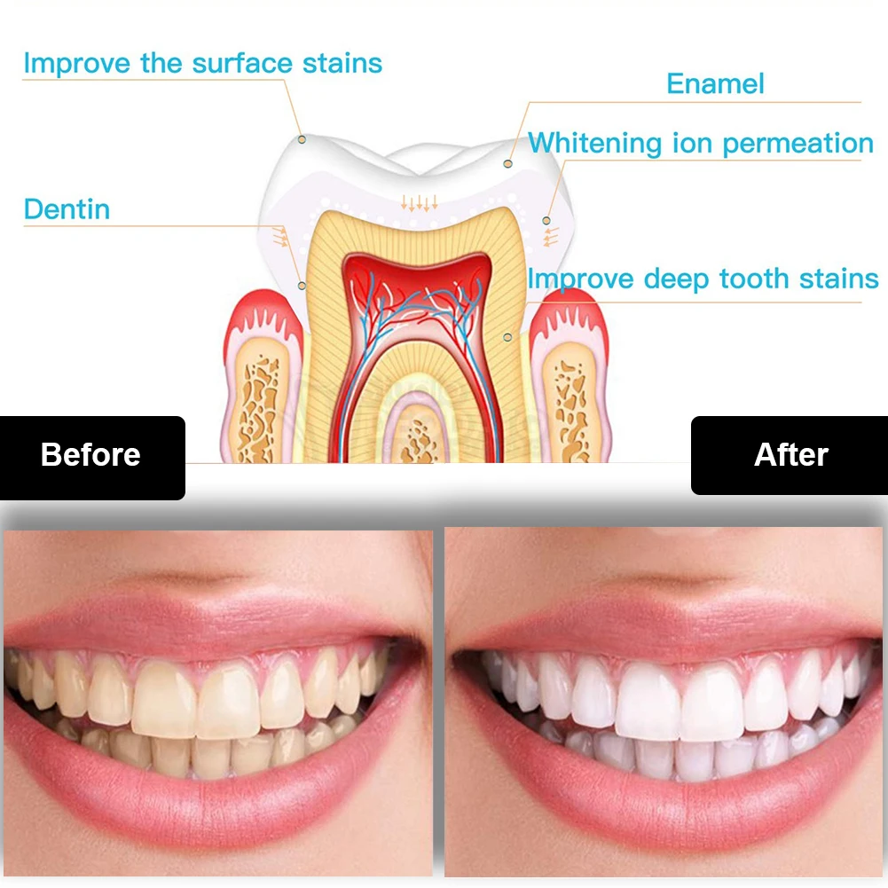 Dental Teeth Whitening Kit Min - Teeth Whitening With Blue Light recensie en prijs