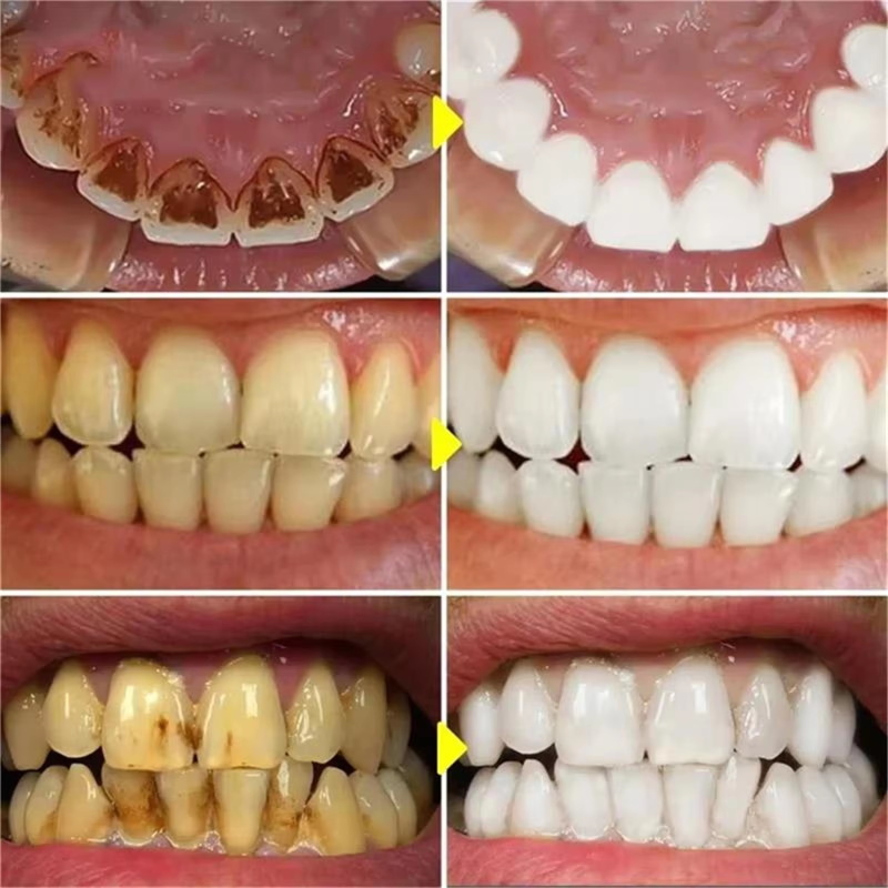 V34 Teeth Whtening Pen Toothpa - Whitening Pen Bleach recensie en prijs