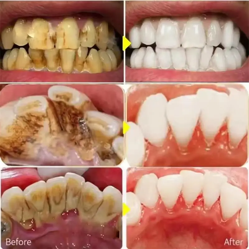 Fast Teeth Whtening Toothpaste - Whitening Pen Bleach recensie en prijs