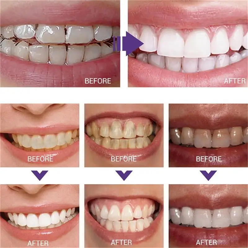 Fast Teeth Whtening Toothpaste - Whitening Pen Bleach recensie en prijs